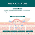 Silicone Scar Sheet